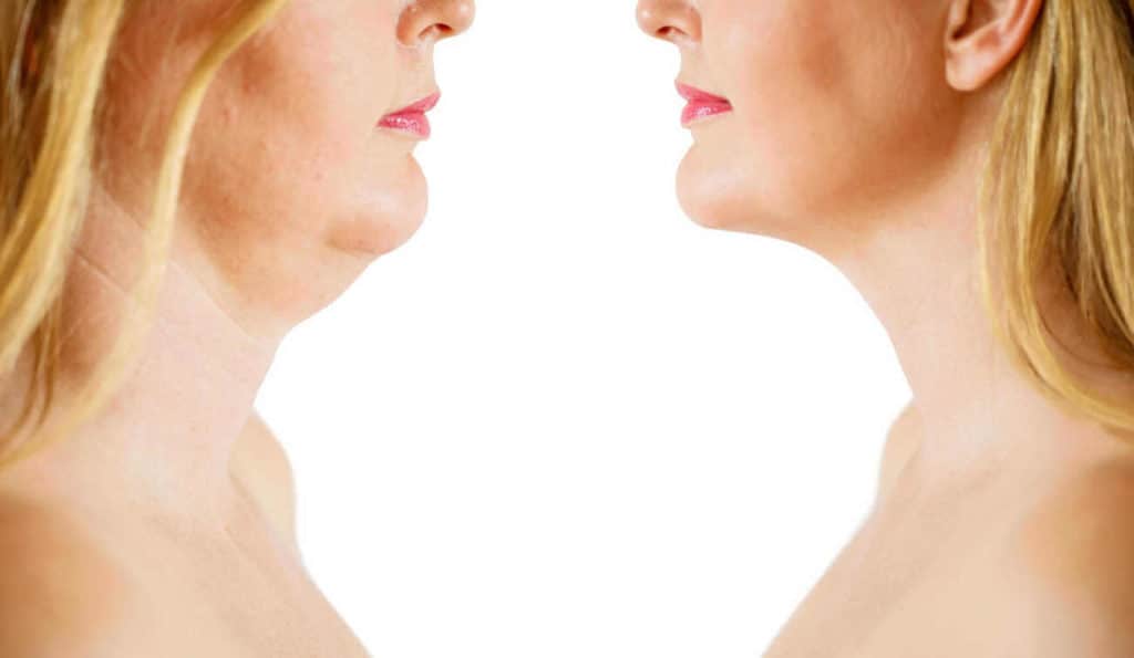 Double Chin treatment Hitchin before and after results
