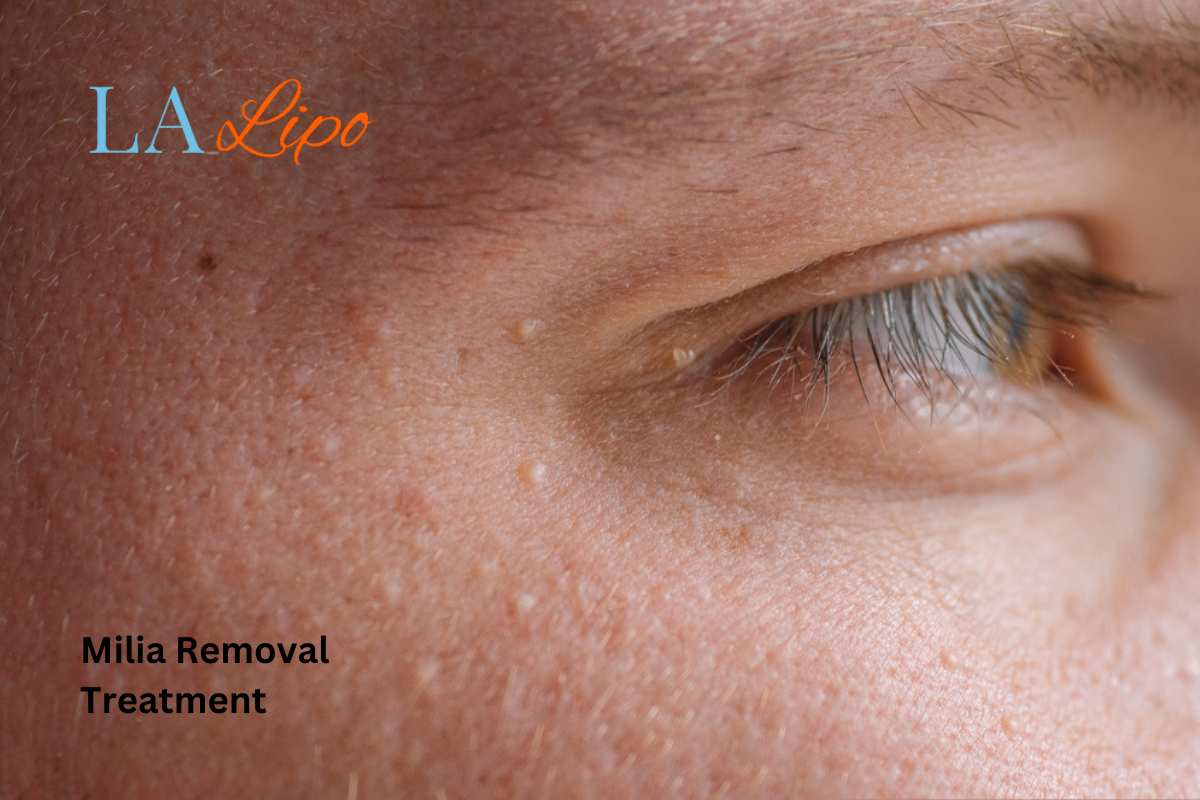 Cryopen Milia Removal: Is It the Easiest and Safest Option Hitchin?