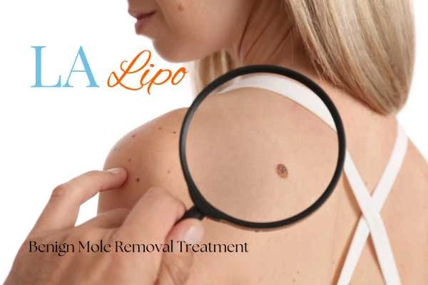 Woman having her inspection of blemish before mole removal Hitchin