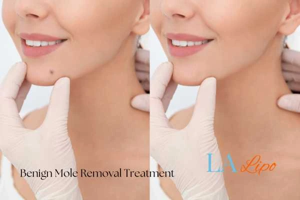 woman's before and after mole removal Hitchin results