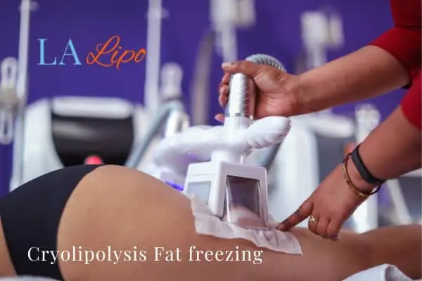 women getting fat freezing Hitchin