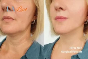 hi-fu for wrinkles Hitchin before and after results