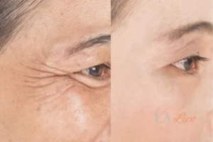 Before and after results of woman - HI-fu wrinkles reduction treatment Hitchin