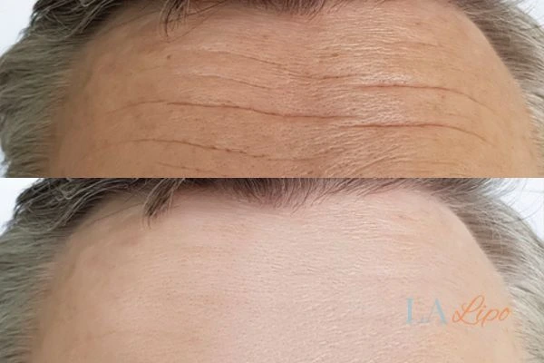 results of HIFU Hitchin on mans forehead to help reduce lines and wrinkles