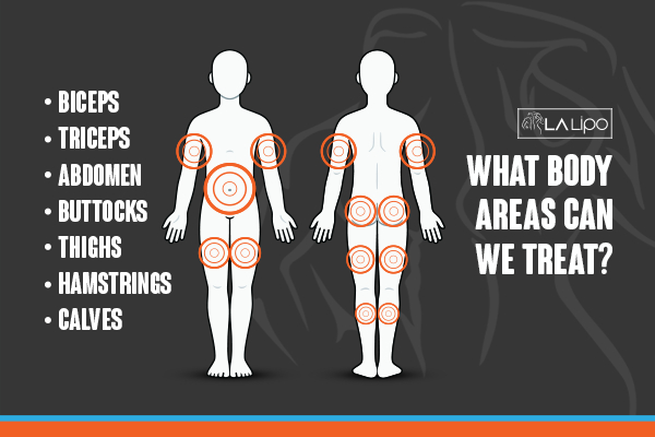 Graphic to show areas you can have LA-EMS Body Sculpting Hitchin treatment.
