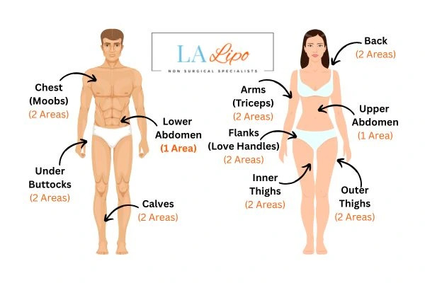 LA LIPO Cryolipolysis Areas Hitchin