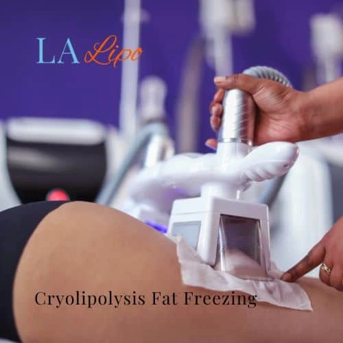 fat freezing - Cryolipolysis Hitchin