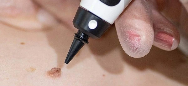 skin tag removal using cryopen Hitchin