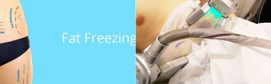 multi areas of a persons body having coolsculpting Hitchin treatment