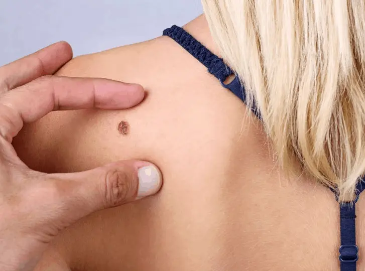 woman having mole removal Hitchin consultation before treatment.