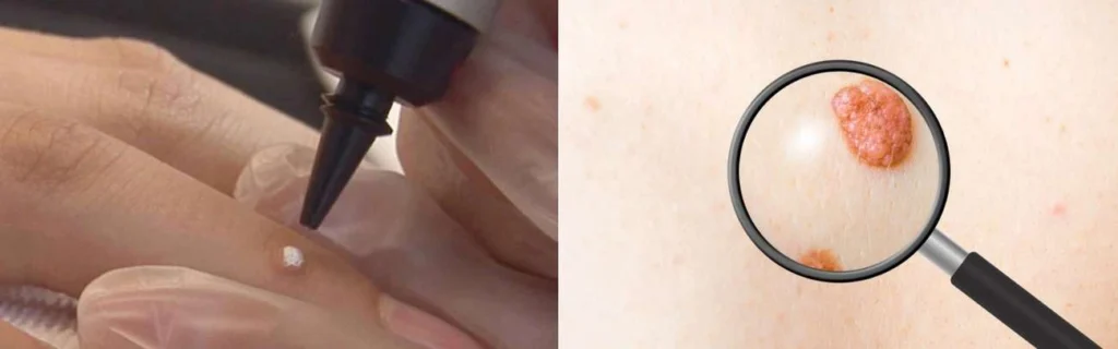 Person getting moles removed with cryopen Hitchin