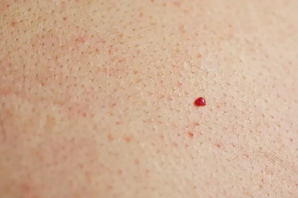 close up of a cherry angioma Hitchin