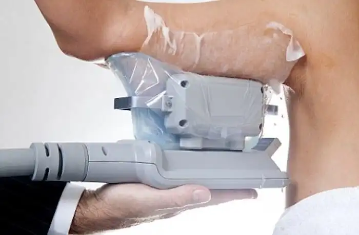 Picture of fat freezing Hitchin on the upper arms.