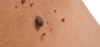 image of a skin tag Hitchin