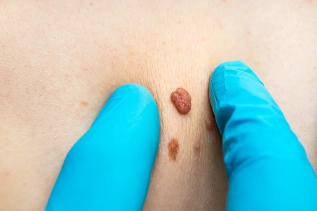 Consultant examining a skin tag Hitchin