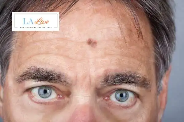 Solar Lentigo Removal Hitchin image of man with mark on his forehead