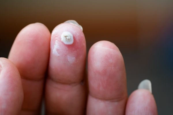 wart on person finger - cryotherapy to treat from LA LIPO Hitchin