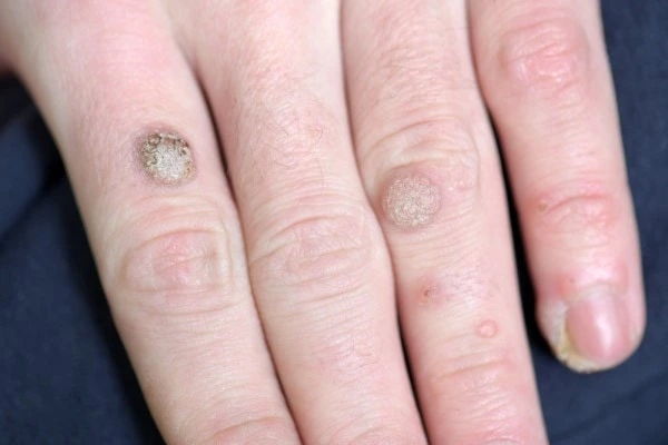 photo of warts on person hand - see wart removal Hitchin from LA LIPO