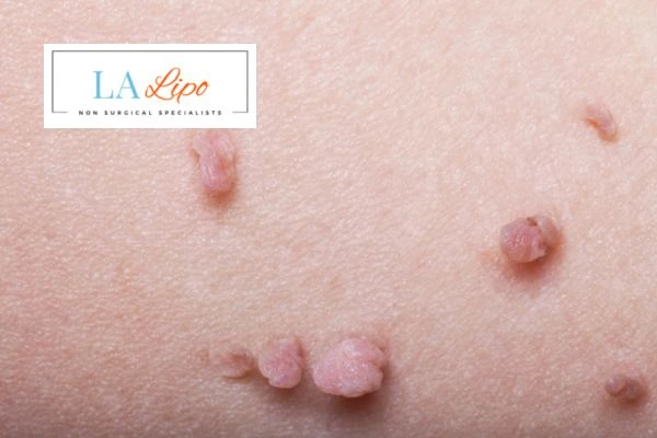 Does cryopen skin tag removal Hitchin hurt? Find out now call our team today!