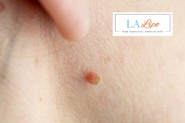 Book skin tag removal Hitchin today speak to our team now!