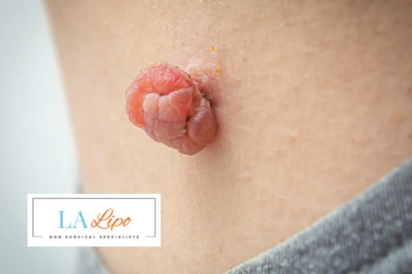Interested in skin tag removal Hitchin? Concerned about the pain? Find out more today!