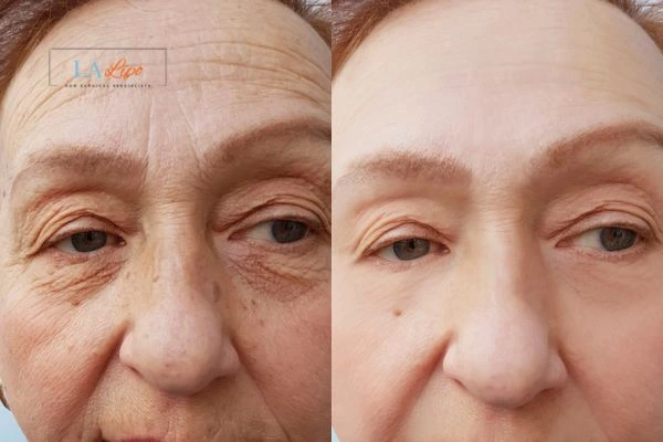 The powerful benefits of Morpheus8 Treatment Hitchin - Call Our team today!