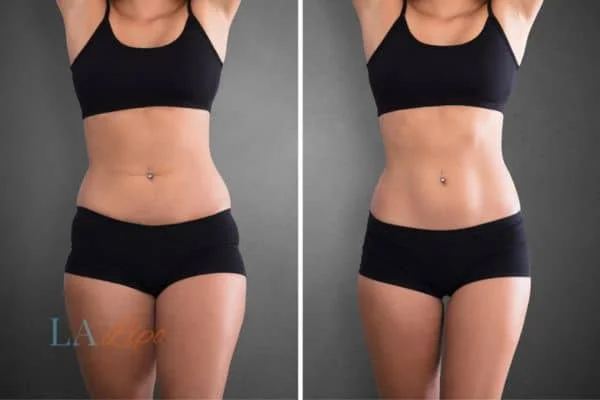 before and after results of non-surgical treatment to help a woman's body image and mental health Hitchin