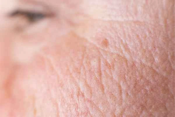 close up picture of a woman's face showing an age spot Hitchin