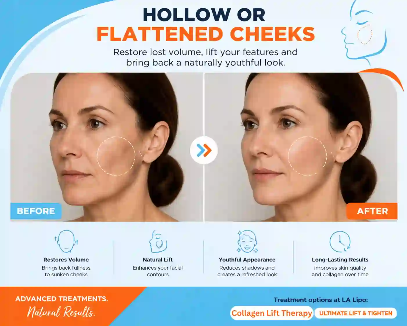 Sign #4: Hollow or Flattened Cheeks Hitchin