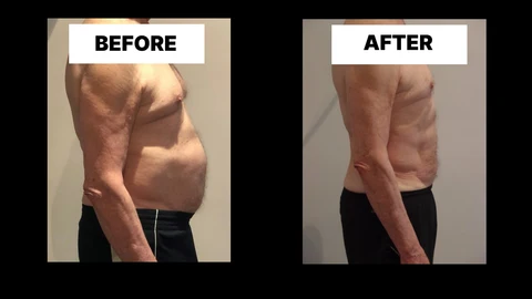 What Symptoms Can Diastasis Recti Cause in Men? Weak Core, Back Pain and Poor Posture Hitchin